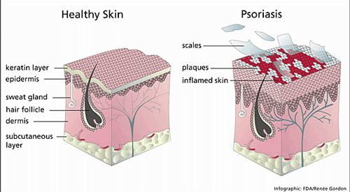 Photos Of Psoriasis