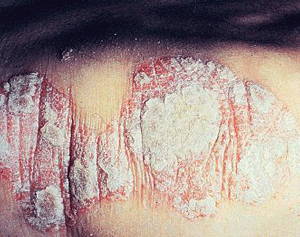 Sample of psoriasis.